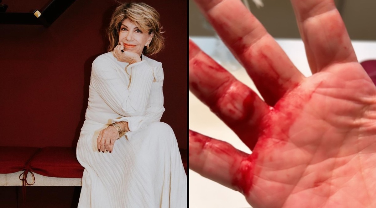 A apresentadora compartilhou nas redes sua mão ferida após o incidente