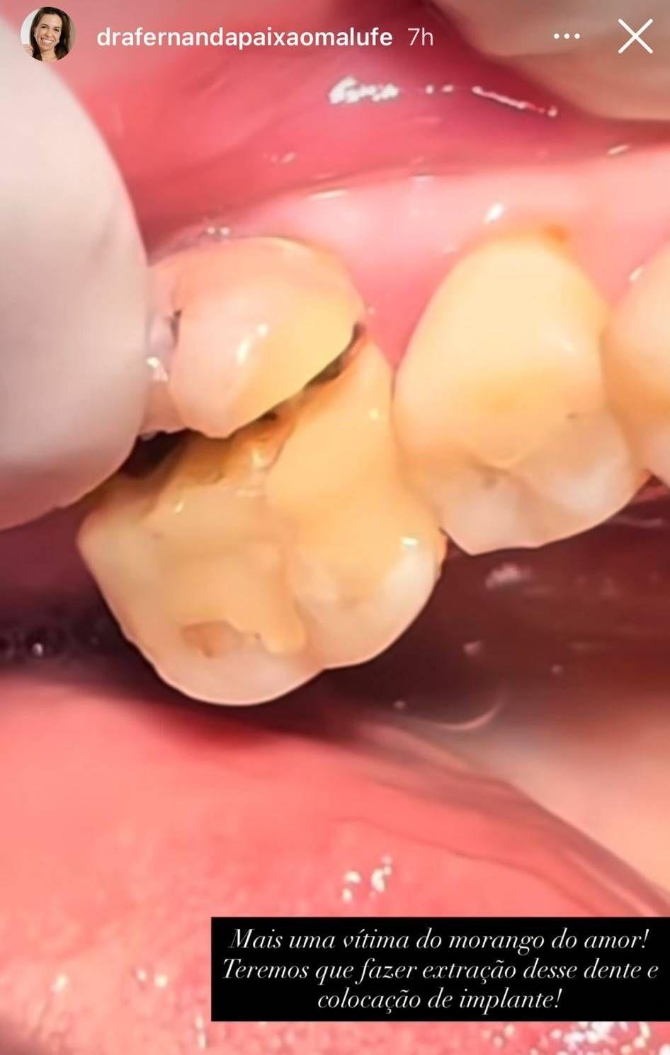 Dentista revela caso de perda dentária após consumo excessivo de morango do amor.