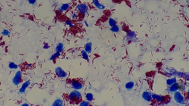 Amostra de lesão cutânea com presença da bactéria Mycobacterium leprae (estruturas em vermelho), observada em microscópio com aumento de 1.000 vezes.