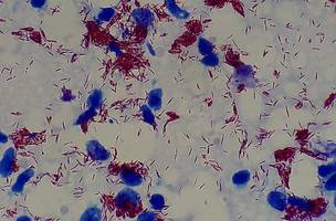 Amostra de lesão cutânea com presença da bactéria Mycobacterium leprae (estruturas em vermelho), observada em microscópio com aumento de 1.000 vezes. (Foto: Ajay Kumar Chaurasiya)