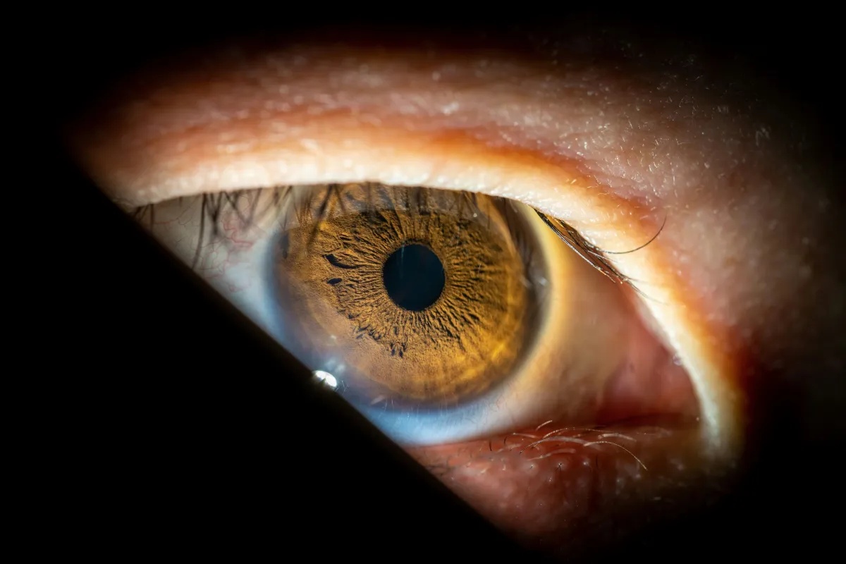 Nova técnica poderá tratar glaucoma e catarata em um único procedimento pelo SUS.